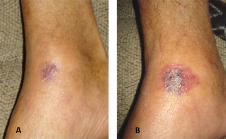 عدوى جرح Vibrio vulnificus سريعة التطور ومميتة