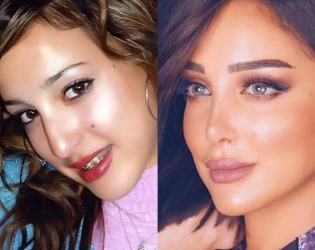 بسمة بوسيل قبل وبعد عمليات التجميل 